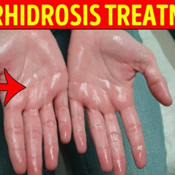 Sweaty Palms: Understanding And Managing Hyperhidrosis.