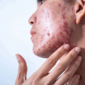 Acne: Causes, Types And Treatment Options
