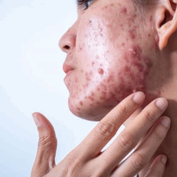 image Acne: Causes, Types And Treatment Options