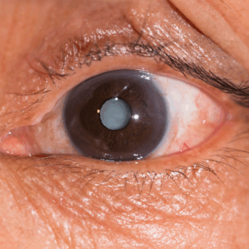 image CATARACTS: CAUSES, SYMPTOMS, AND TREATMENTS