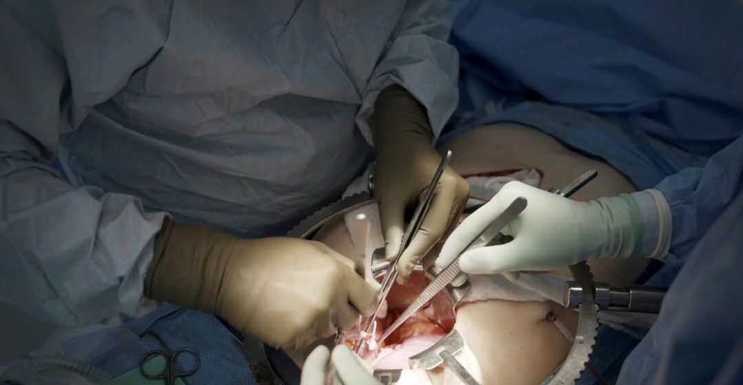 WhatsApp Image 2025-11-04 at 08.40.29_2c2a3aa8 First Clinical Trial Of Pig Kidney Transplants Gets Underway