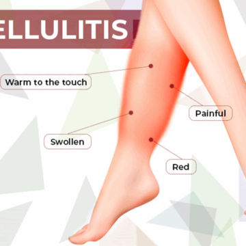  CELLULITIS: CAUSES, SYMPTOMS, AND TREATMENT