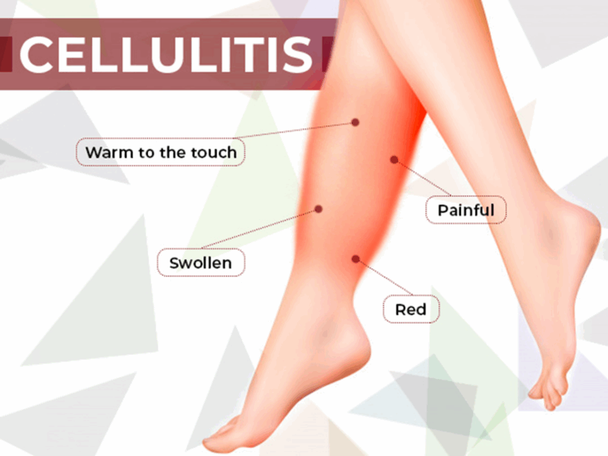  CELLULITIS: CAUSES, SYMPTOMS, AND TREATMENT