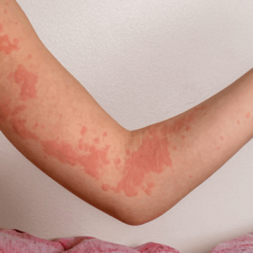Eczema: A Guide To Managing The Itch 