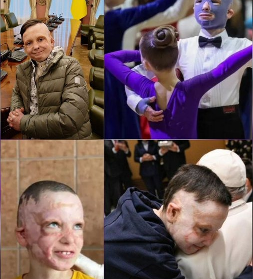 11-Year-Old Ukrainian Roman Oleksiv, Describes Surviving Russia’s July 14, 2022 Strike On Vinnytsia, At The European Parliament