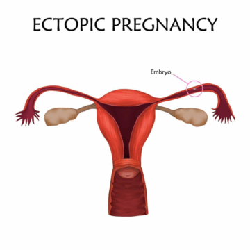 ECTOPIC PREGNANCY