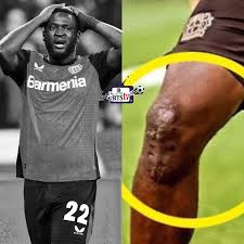 Victor Boniface Recovery Journey After Knee Surgery