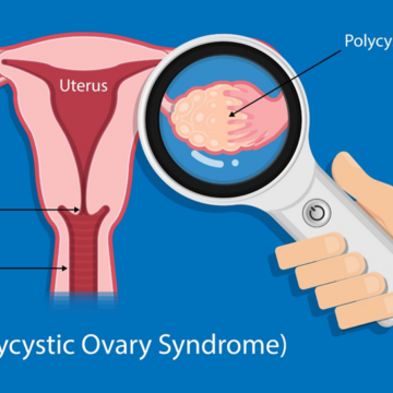 Understanding Polycystic Ovary Syndrome (PCOS) – Causes, Symptoms, And Management.