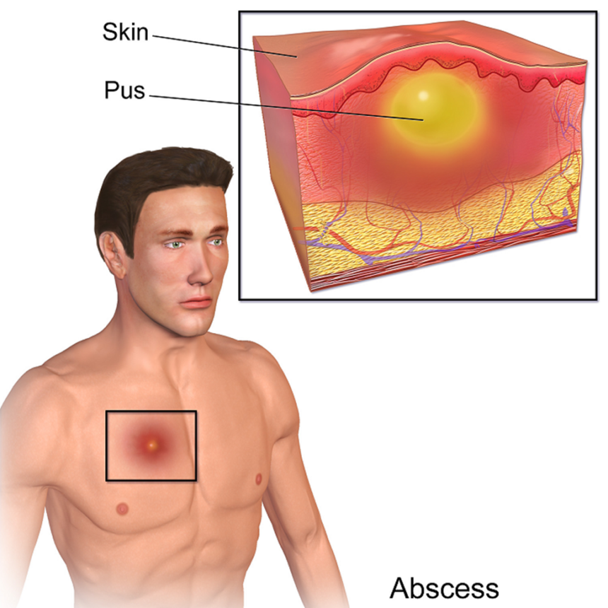 Abscesses: Causes, Symptoms And Treatments